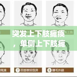 突发上下肢瘫痪，单侧上下肢瘫痪 